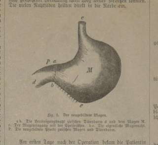 Medizin Verdauungsapparat 2 Blätter 5 Holzstiche 1882  